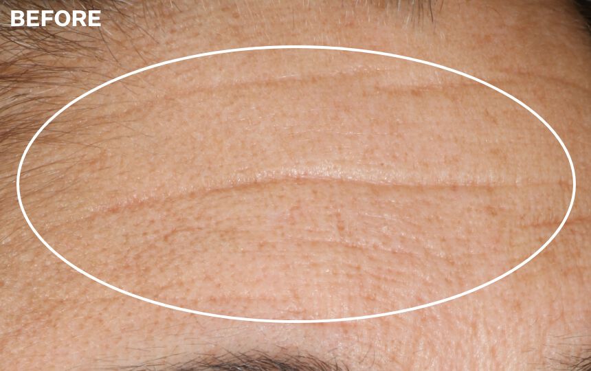 Results of using Advanced Retinol Nightly Renewal Moisturizer for 4 weeks when used as directed.</p> Individual results will vary.