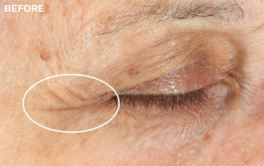 Results of using Advanced Retinol Multi-Correct Eye Cream as directed. </p>Individual results will vary.