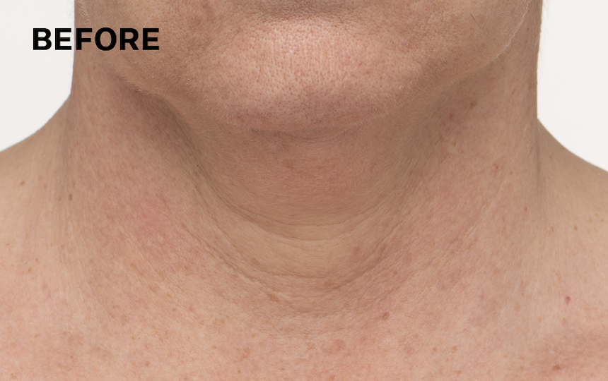 Results of using TL Advanced™ Tightening Neck Cream PLUS for 4 weeks when used as directed. </p>Individual results will vary.