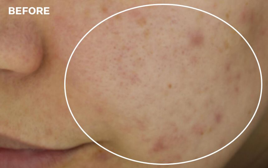 After 8 weeks when Multi-Action Clear Blemish Control System is used as a regimen.</p>Individual results will vary.