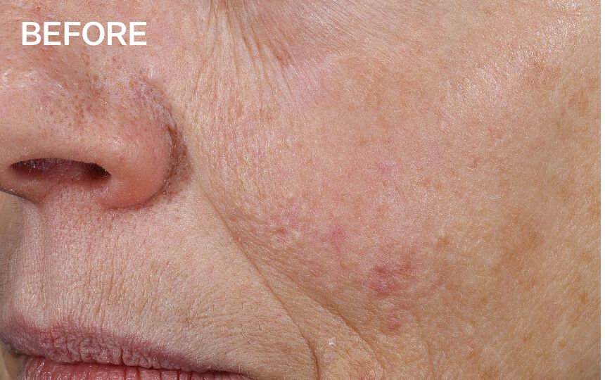 Based on using the cream as directed for 1 week. Individual results will vary.
