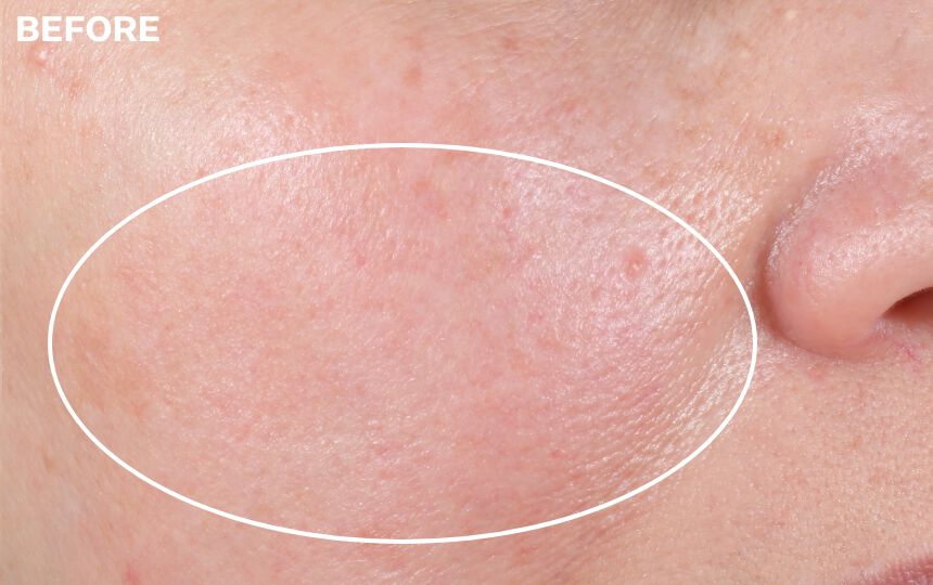 Results of using Advanced Retinol Nightly Renewal Moisturizer for 4 weeks when used as directed.</p> Individual results will vary.