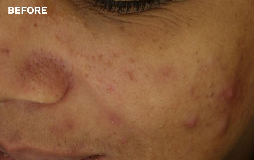 After 8 weeks when Multi-Action Clear Blemish Control System is used as a regimen.</p>Individual results will vary.