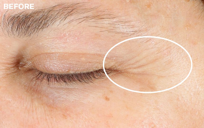 Results of using Advanced Retinol Multi-Correct Eye Cream as directed. </p>Individual results will vary.