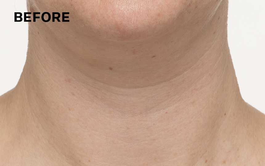 Results of using TL Advanced™ Tightening Neck Cream PLUS for 4 weeks when used as directed. </p>Individual results will vary.