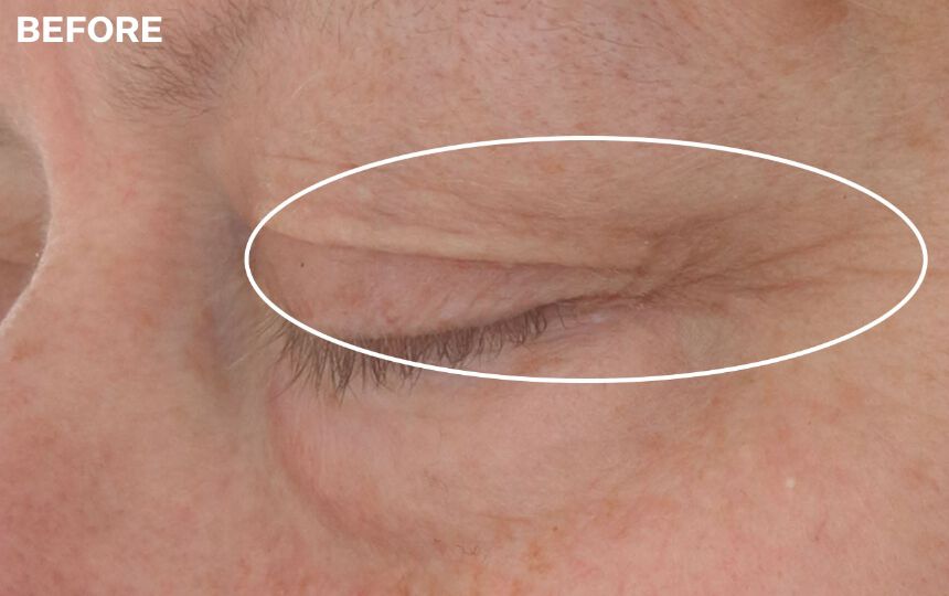 After using Hyaluronic Tripeptide Gel-Cream for Eyes for 4 weeks. </p>Individual results will vary.
