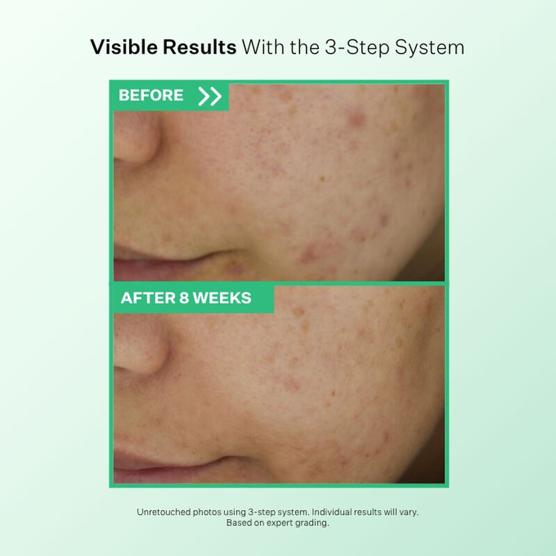 Visible Results from using Multi-Action Clear Gentle Daily Clarifying Cleanser