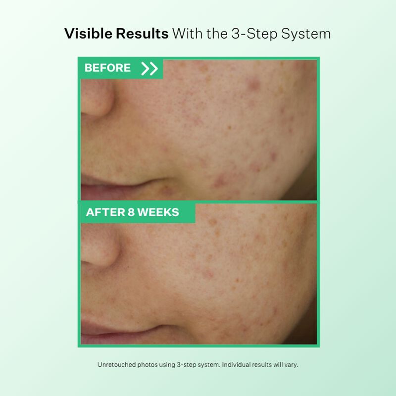 Visible Results from using the Multi-Action Clear Blemish Clearing System
